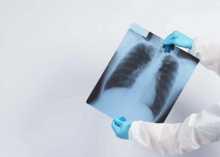 filme de raio x de danos aos pulmoes de covid-19 e retencao pela mao medico em uma luva medica