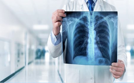 Como as nanopartículas estão revolucionando a luta contra o câncer de pulmão